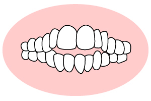 歯と歯の間が開いている～正中離開・すきっ歯・空隙歯列～